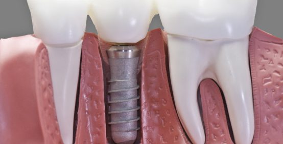 Dental Implants Arlington Heights