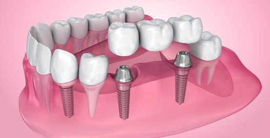 Implant Dentistry Services Arlington Heights