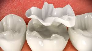 Kensington Dental Onlay Procedure