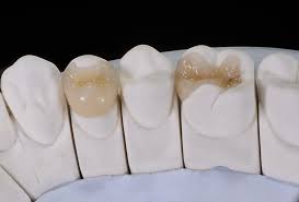 Inlay Dental Restoration Arlington Heights IL