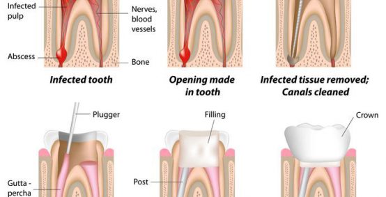 Root Canal Treatment in Arlington Heights
