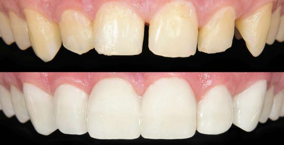 Cosmetic Dental Bonding Arlington Heights