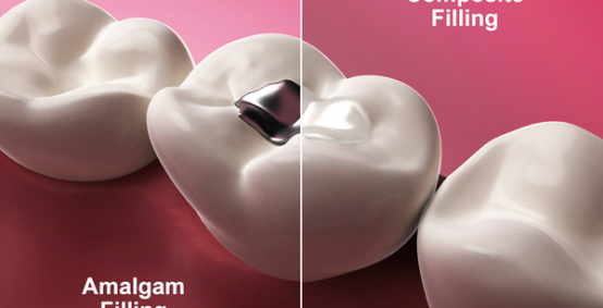 Dental Fillings in Arlington Heights IL