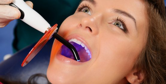 Dental Fillings in Arlington Heights IL