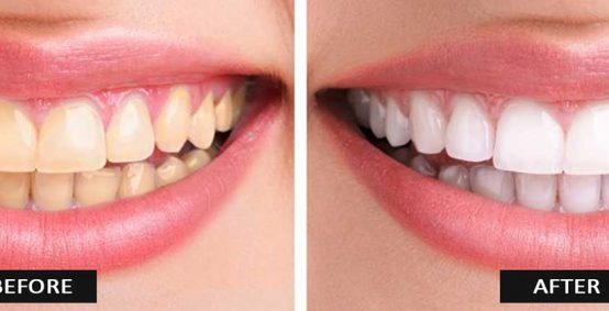 Teeth Whitening in Arlington Heights