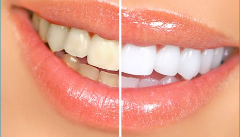 Teeth Whitening in Arlington Heights