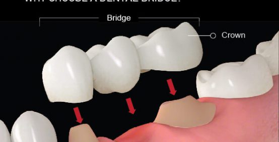 Dental Bridges Arlington Heights IL