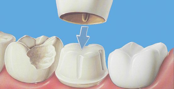 Dental Crowns in Arlington Heights