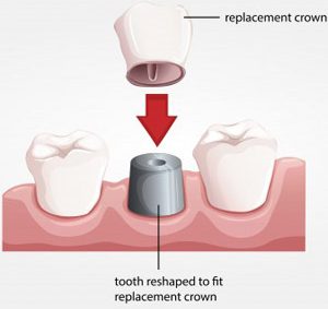 Dental Crowns in Arlington Heights