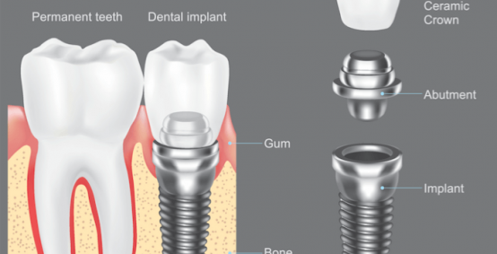 Dental Implants Arlington Heights