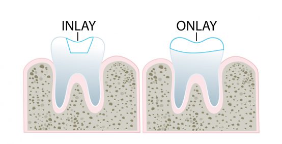 Kensington Dental Onlay Procedure