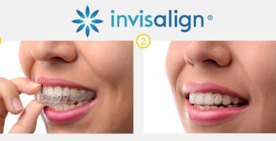 Affordable Invisalign Braces Arlington Heights