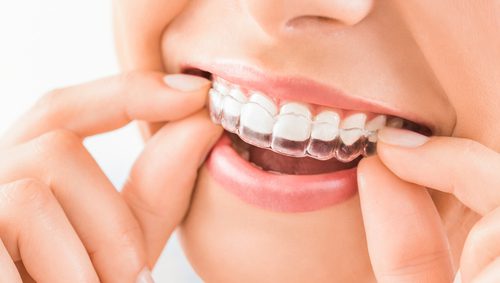 Affordable Invisalign Braces Arlington Heights