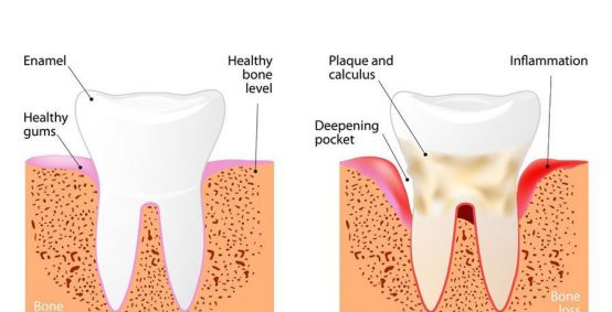 Kensington Periodontal Scaling Services