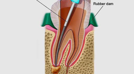 Root Canal Treatment in Arlington Heights