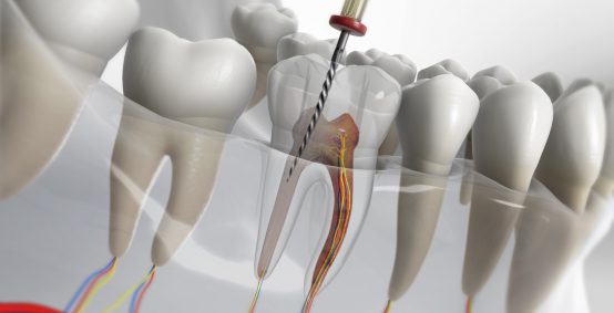 Root Canal Treatment in Arlington Heights