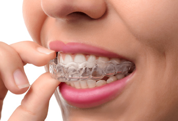 Invisalign