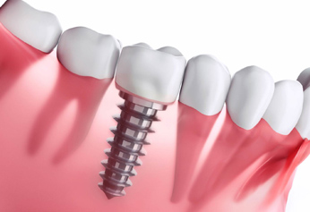 Dental Implants